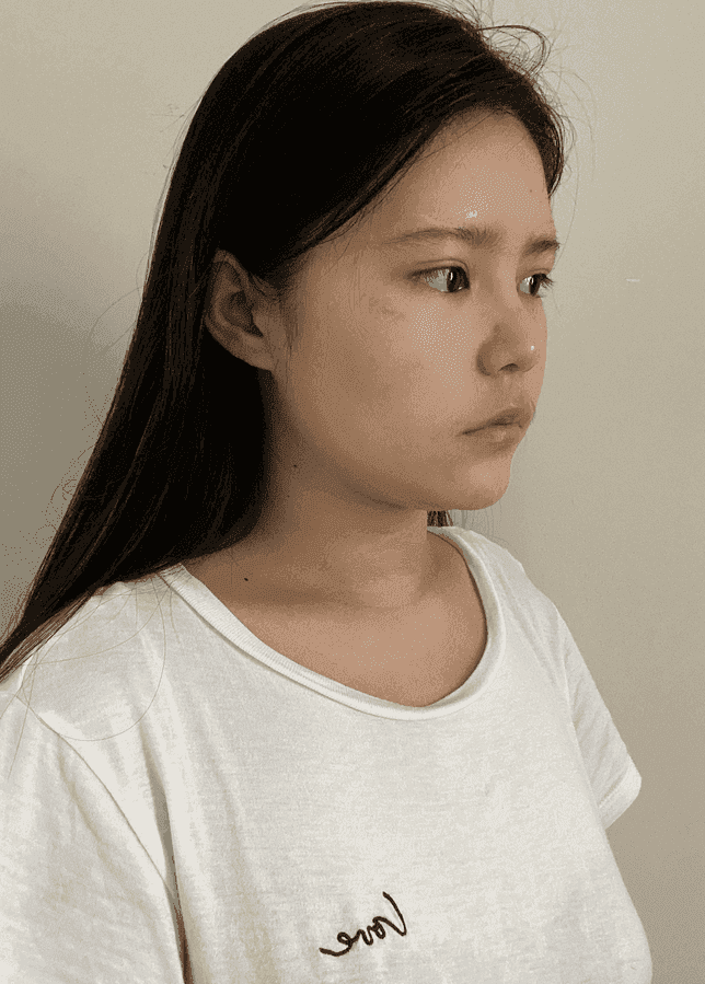 長沙亞韓整形醫(yī)院怎么樣？附隆鼻案例分享+價格表