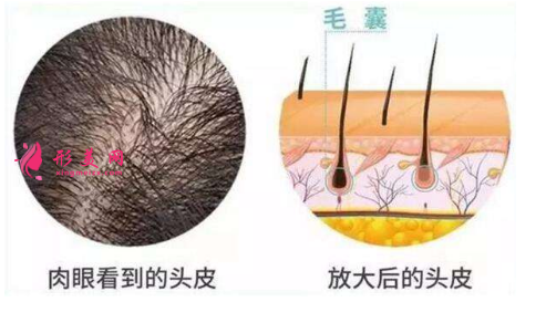 頭發(fā)種植效果可靠嗎？術(shù)前注意事項(xiàng)大全！