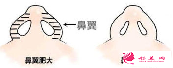 鼻翼縮小手術(shù)的疤痕怎么處理