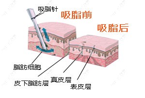 抽脂前后對(duì)比