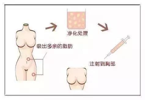 劉露 自體脂肪移植你不知道的那些事