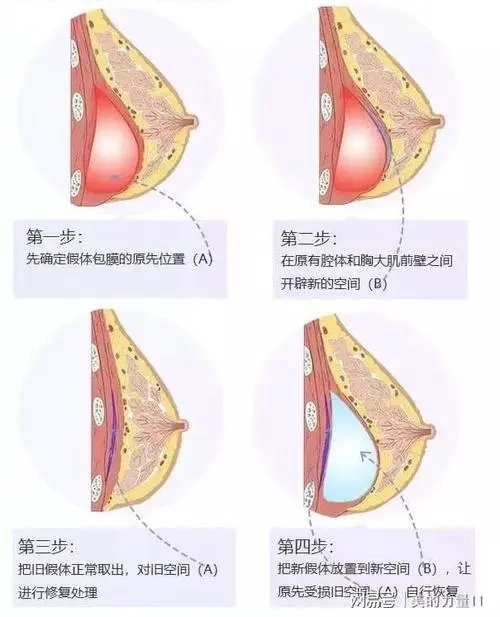 上海豐胸的價格是多少?豐胸手術(shù)有哪些方法?