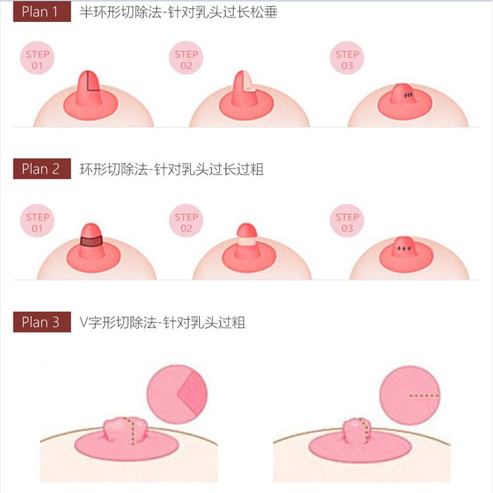 乳頭縮小會(huì)影響母乳喂養(yǎng)嗎？乳頭縮小手術(shù)的特點(diǎn)是什么?