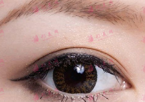 內(nèi)眼角開大了怎么辦？內(nèi)眼角修復(fù)皮瓣轉(zhuǎn)移方法