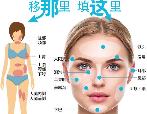 面部填充的方式|面部填充后為什么皮膚會下垂？