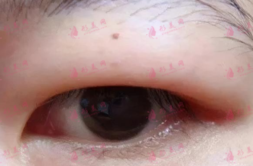 不同類型腫泡眼的不同手術(shù)方法|腫泡眼去脂肪后會反彈嗎？