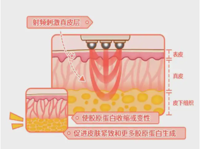 去皺紋就選擇熱瑪吉?那么熱瑪吉除皺果能維持多長時間?