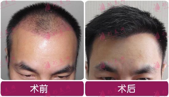 國(guó)內(nèi)植發(fā)一般是什么價(jià)格？看看植發(fā)多少錢一個(gè)單位