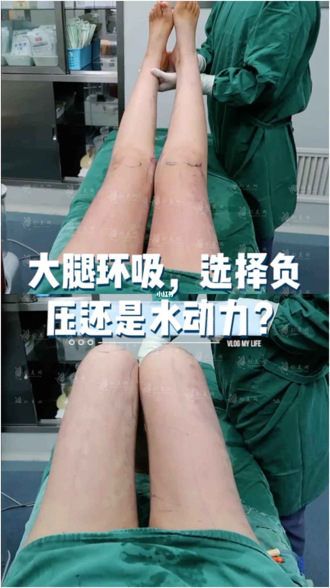 水動(dòng)力吸脂手術(shù)收費(fèi)價(jià)格貴嗎?