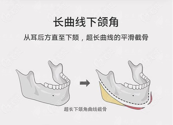 圣嘉新張笑天輪廓科普：下頜角手術(shù)磨骨好還是削骨好呢