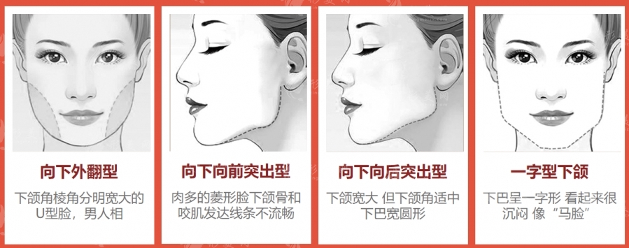 圣嘉新張笑天輪廓科普：下頜角手術(shù)磨骨好還是削骨好呢
