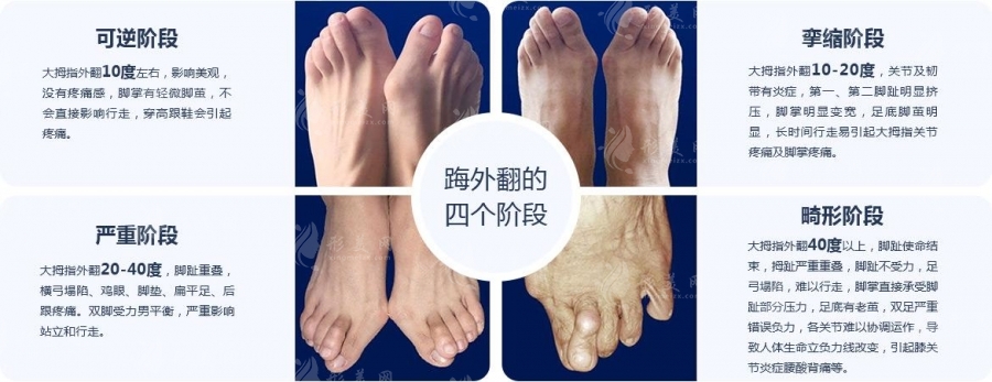 溫建民拇外翻微創(chuàng)手術多少錢？相比馬桂文做大腳骨收費誰更高？