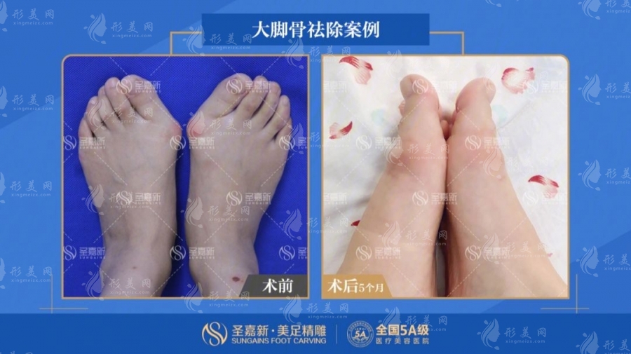 北京圣嘉新醫(yī)療美容醫(yī)院大腳骨部分案例展示