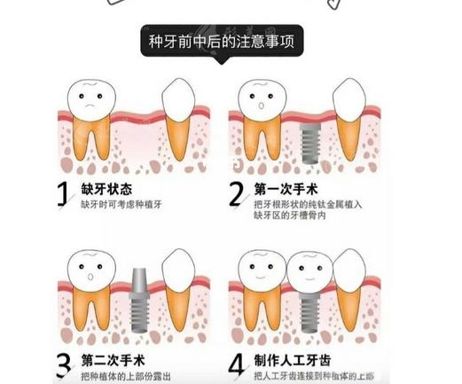 北京種植牙價(jià)格一覽表2023-費(fèi)用影響因素-注意事項(xiàng)