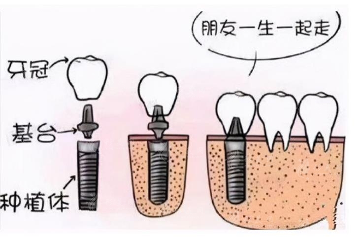 北京種植牙價(jià)格一覽表2023-費(fèi)用影響因素-注意事項(xiàng)