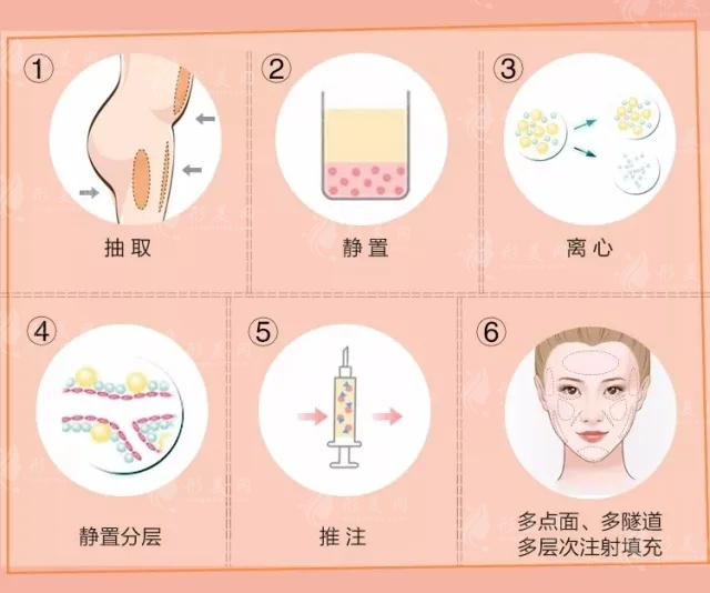 脂肪填充