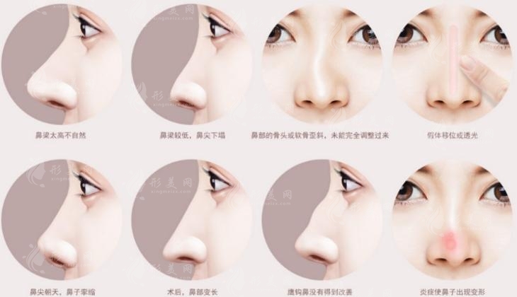 重慶李喆做高難度鼻修復(fù)-鼻再造技術(shù)底蘊(yùn)深厚