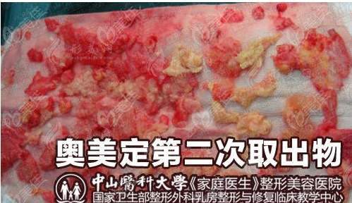 黃廣香奧美定取出修復價格表：9000元-51000元起