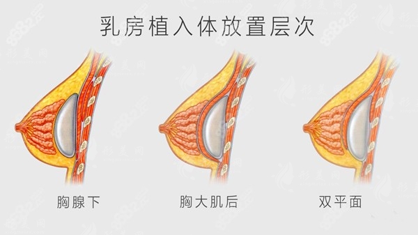 揭曉南京夏建軍和黃名斗哪個技術(shù)好？假體隆胸參考價格優(yōu)勢在線預(yù)約！