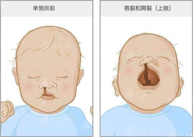 兔唇會遺傳嗎