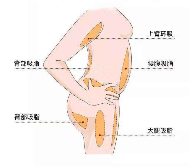 北京顧云鵬手臂吸脂手術(shù)費(fèi)用多少錢？附新價(jià)格表