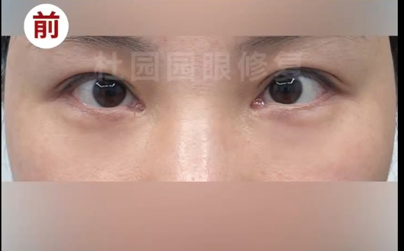 解密內眼角圓形洞修復的奧秘：杜園園醫(yī)生的精湛技術