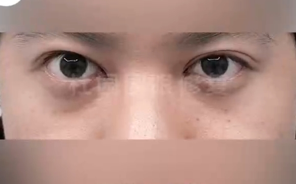杜園園眼修復，打造美麗雙眼：告別雙眼皮過窄煩惱
