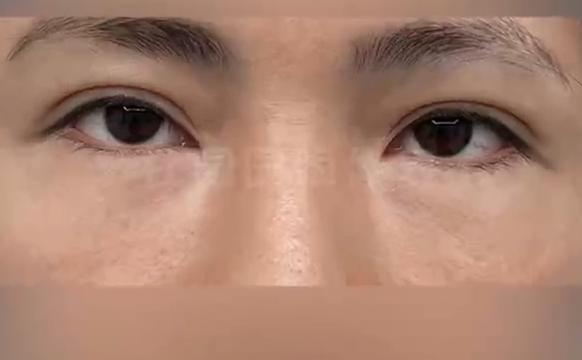 重塑獨特魅力：上海愛尚麗格打造驚艷人造雙眼皮