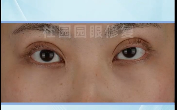 雙眼皮失敗怎么辦？上海愛尚麗格提肌撕脫修復解決你的煩惱！