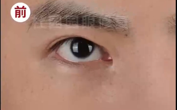 修復內眼角豁口：杜園園醫(yī)生的雙眼皮松脫修復術，讓你重獲美麗