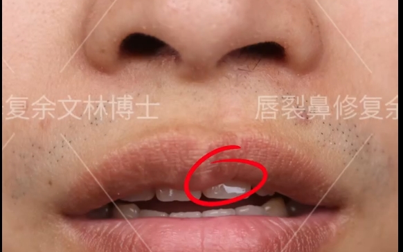 徹底告別唇裂困擾：余文林醫(yī)生唇裂修復案例分享 