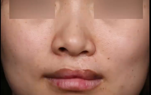 余文林醫(yī)生：重塑美麗，告別左側(cè)唇裂和鼻子輕微畸形
