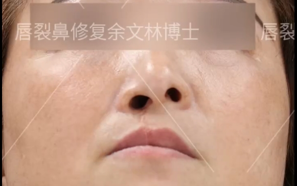 唇裂修復后，鼻子為什么還是歪的？余文林醫(yī)生詳解