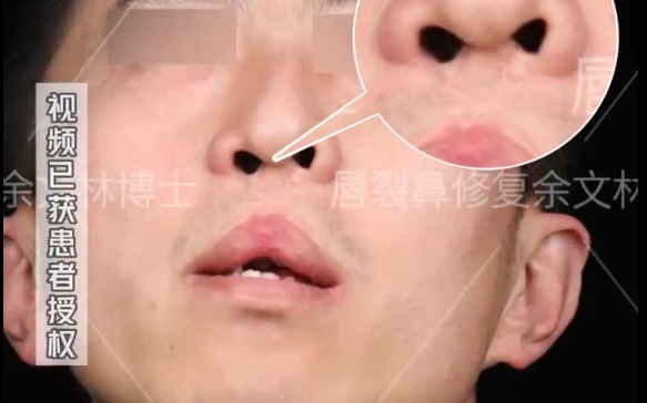 如何解決雙側(cè)唇裂問題？余文林醫(yī)生案例分享，擺脫鷹嘴般的唇形