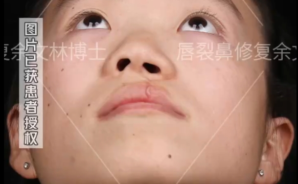 余文林醫(yī)生揭秘：小時候的唇裂沒修復好會變成怎么樣？