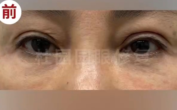 雙眼皮注射脂肪失敗怎么辦？跟隨杜園園醫(yī)生修復再次美麗