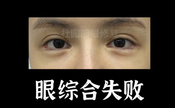 杜園園醫(yī)生揭秘：為什么眼綜合失敗后要避免多個項目一起修復(fù)？