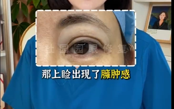 揭秘上眼瞼脂肪注射不滿意的真相！上海愛(ài)尚麗格專家解答你為什么