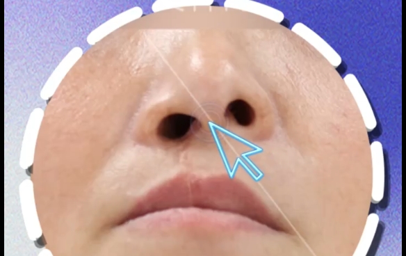 患側(cè)vs健側(cè)鼻孔大，哪種更好修復？余文林醫(yī)生分析