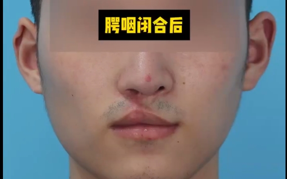唇腭裂修復(fù)優(yōu)先：先變美還是先矯正？余文林醫(yī)生答案揭秘