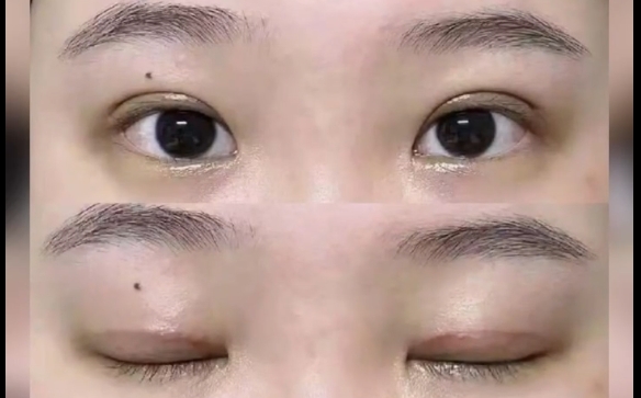 周顯玉醫(yī)生為你解答埋線雙眼皮媽生感問題，告別困擾 