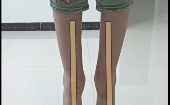 程辰醫(yī)生揭秘：酒杯腿與筷子腿，如何選擇？ 