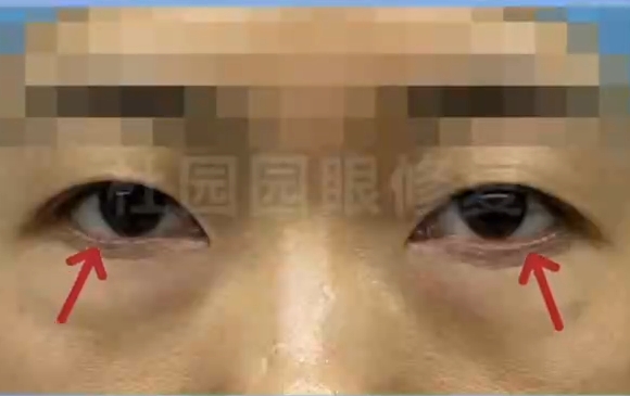 疤痕痕跡不再困擾！上海愛尚麗格眼袋術(shù)后瞼緣恢復專家