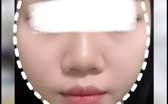 普通女孩做面部吸脂，奉勸先了解好這些！