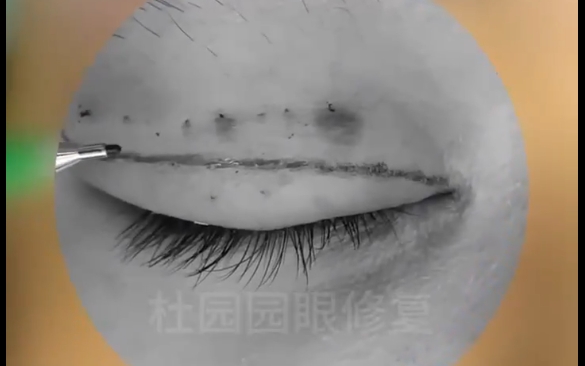 眼修復不祛皮，原疤痕怎么辦？杜園園醫(yī)生為你解答
