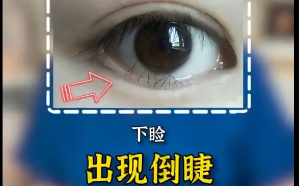 為何做完外眼角下至?xí)a(chǎn)生倒睫現(xiàn)象？上海愛(ài)尚麗格專家解答