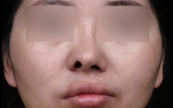 唇裂鼻放膨體后期形狀是否會(huì)改變？余文林醫(yī)生給出解答！