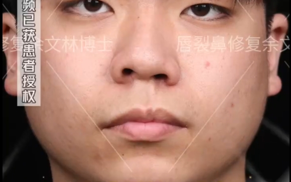 17歲男孩的蛻變：余文林醫(yī)生唇裂鼻修復案例分享