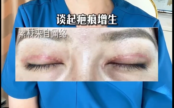 上海愛尚麗格專家揭秘雙眼皮疤痕手術(shù)增生的真相，不是失敗！