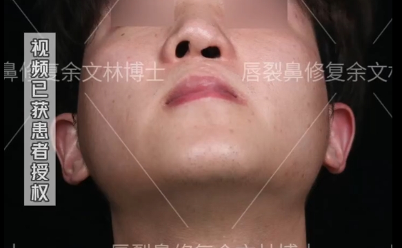 唇裂修復(fù)后的秘密：為什么要戴鼻撐？余文林醫(yī)生解答